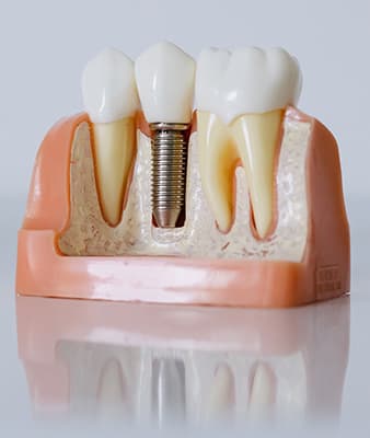 Cross-section model showing a titanium dental implant placed in the jawbone